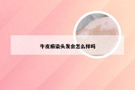 牛皮癣染头发会怎么样吗