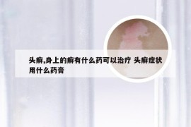 头癣,身上的癣有什么药可以治疗 头癣症状用什么药膏