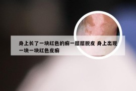 身上长了一块红色的癣一层层脱皮 身上出现一块一块红色皮癣