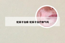 蛇床子治癣 蛇床子治疗脚气吗