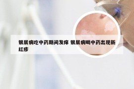 银屑病吃中药期间发痒 银屑病喝中药出现新红疹