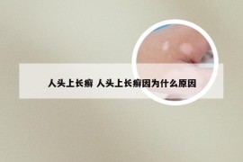 人头上长癣 人头上长癣因为什么原因