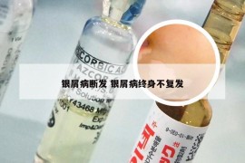 银屑病断发 银屑病终身不复发