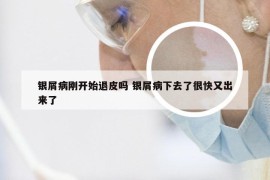 银屑病刚开始退皮吗 银屑病下去了很快又出来了