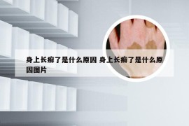 身上长癣了是什么原因 身上长癣了是什么原因图片