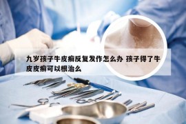 九岁孩子牛皮癣反复发作怎么办 孩子得了牛皮皮癣可以根治么