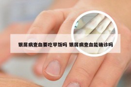 银屑病查血要吃早饭吗 银屑病查血能确诊吗