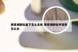 银屑病脚趾盖下怎么去除 银屑病脚趾甲变厚怎么办