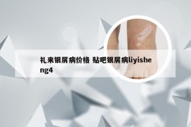 礼来银屑病价格 贴吧银屑病liyisheng4