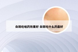 白斑吃啥药效果好 白斑吃什么药最好