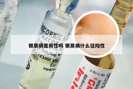 银屑病是阴性吗 银屑病什么征阳性