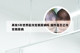 再有5年世界能攻克银屑病吗 国外是否已攻克银屑病