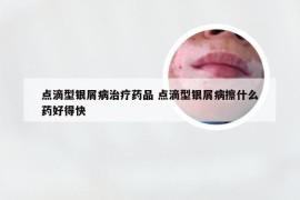 点滴型银屑病治疗药品 点滴型银屑病擦什么药好得快