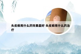 头皮癣用什么药效果最好 头皮癣用什么药治疗