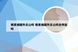 银屑病国外忌口吗 银屑病国外忌口吗会传染吗