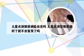 儿童点滴银屑病能自愈吗 儿童点滴型银屑病好了就不会复发了吗