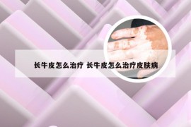 长牛皮怎么治疗 长牛皮怎么治疗皮肤病