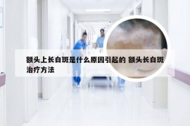 额头上长白斑是什么原因引起的 额头长白斑治疗方法