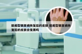 脓疱型银屑病恢复后的皮肤 脓疱型银屑病恢复后的皮肤会变黑吗