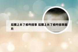 后腰上长了癣咋回事 后腰上长了癣咋回事图片