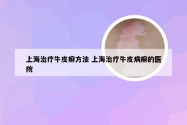 上海治疗牛皮癣方法 上海治疗牛皮病癣的医院