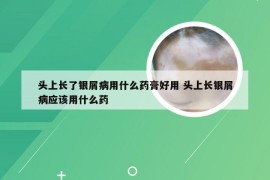 头上长了银屑病用什么药膏好用 头上长银屑病应该用什么药