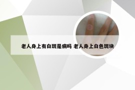 老人身上有白斑是病吗 老人身上白色斑块