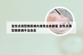 急性点滴型银屑病大爆发全身都是 急性点滴型银屑病不治自愈