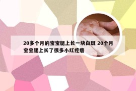 20多个月的宝宝腿上长一块白斑 20个月宝宝腿上长了很多小红疙瘩