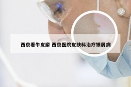 西京看牛皮廨 西京医院皮肤科治疗银屑病