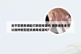 关节型银屑病能打新冠疫苗吗 银屑病患者可以接种新型冠状病毒疫苗吗?