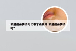 银屑病会传染吗长春华山高端 银屑病会传染吗?