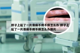 脖子上起了一片像癣不疼不痒怎么办 脖子上起了一片像癣不疼不痒怎么办图片