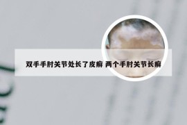 双手手肘关节处长了皮癣 两个手肘关节长癣