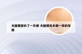 大腿根部长了一片癣 大腿根处长癣一样的东西