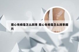 眉心有癣是怎么回事 眉心有癣是怎么回事图片