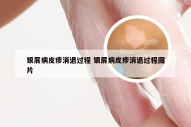 银屑病皮疹消退过程 银屑病皮疹消退过程图片