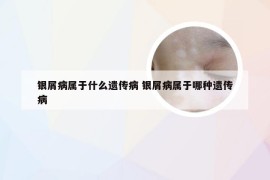 银屑病属于什么遗传病 银屑病属于哪种遗传病