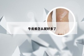 牛皮癣怎么就好多了