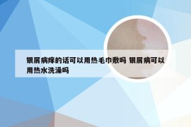 银屑病痒的话可以用热毛巾敷吗 银屑病可以用热水洗澡吗