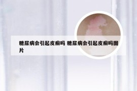 糖尿病会引起皮癣吗 糖尿病会引起皮癣吗图片