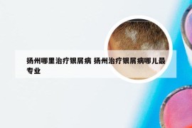 扬州哪里治疗银屑病 扬州治疗银屑病哪儿最专业