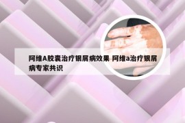 阿维A胶囊治疗银屑病效果 阿维a治疗银屑病专家共识