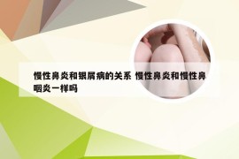 慢性鼻炎和银屑病的关系 慢性鼻炎和慢性鼻咽炎一样吗