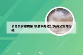 公务员有银屑病 银屑病能过公务员公安体检吗