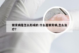 银宵病是怎么形成的 什么是银宵病,怎么治疗?