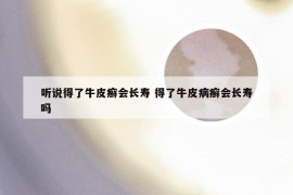 听说得了牛皮癣会长寿 得了牛皮病癣会长寿吗