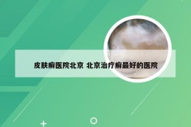 皮肤癣医院北京 北京治疗癣最好的医院