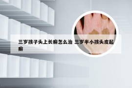 三岁孩子头上长癣怎么治 三岁半小孩头皮起癣