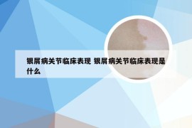 银屑病关节临床表现 银屑病关节临床表现是什么